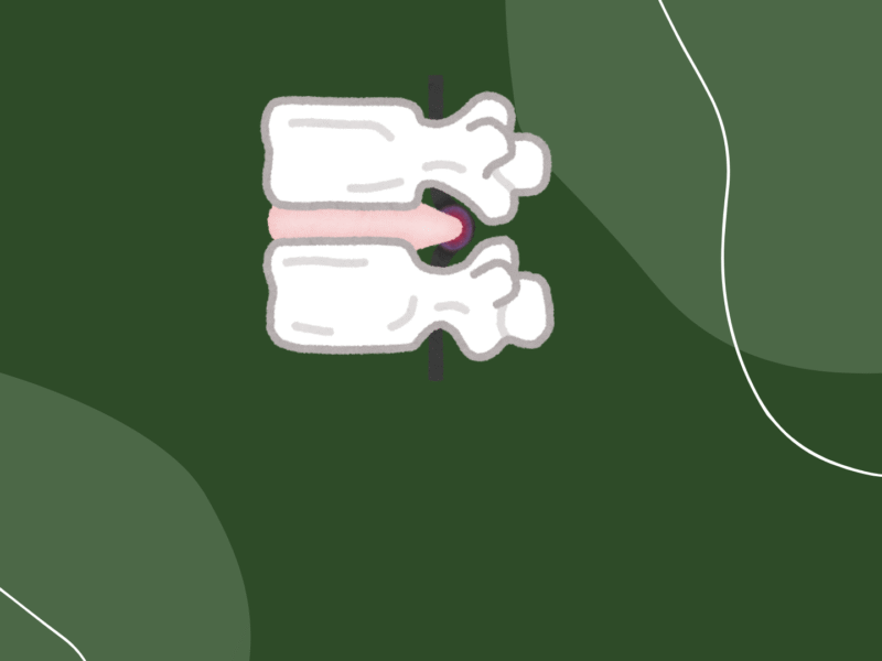 Rwa kulszowa Bydgoszcz – jak wygląda skuteczna rehabilitacja bez operacji?